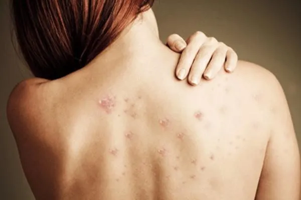 Mặc đồ ẩm ướt khiến gia tăng các bệnh về da